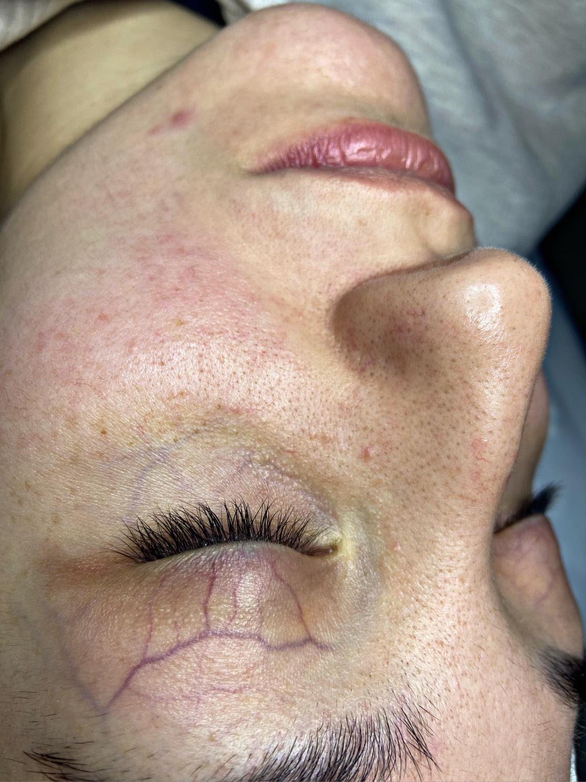 Akne Bakımı Öncesi