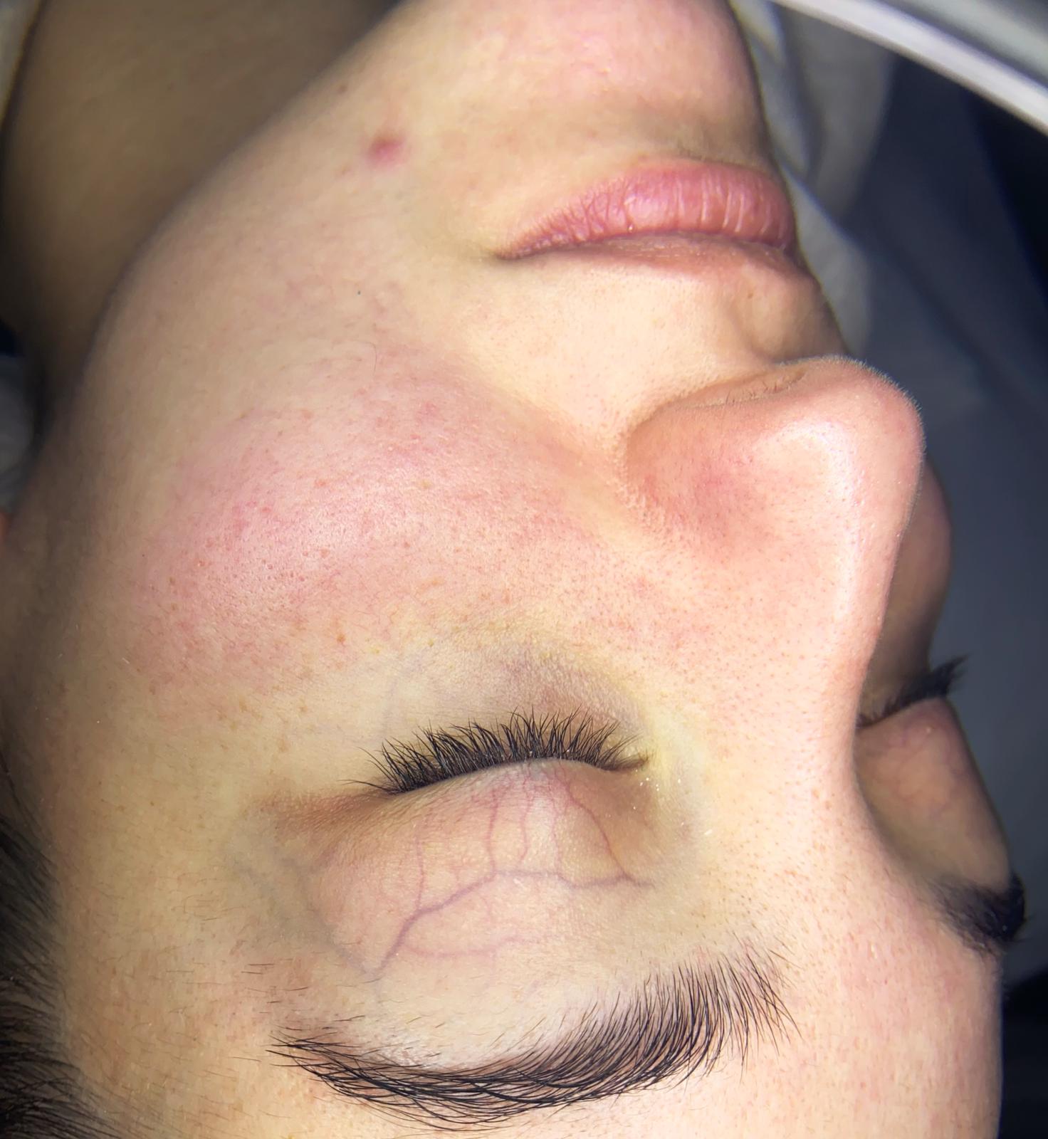 Akne Bakımı Sonrası