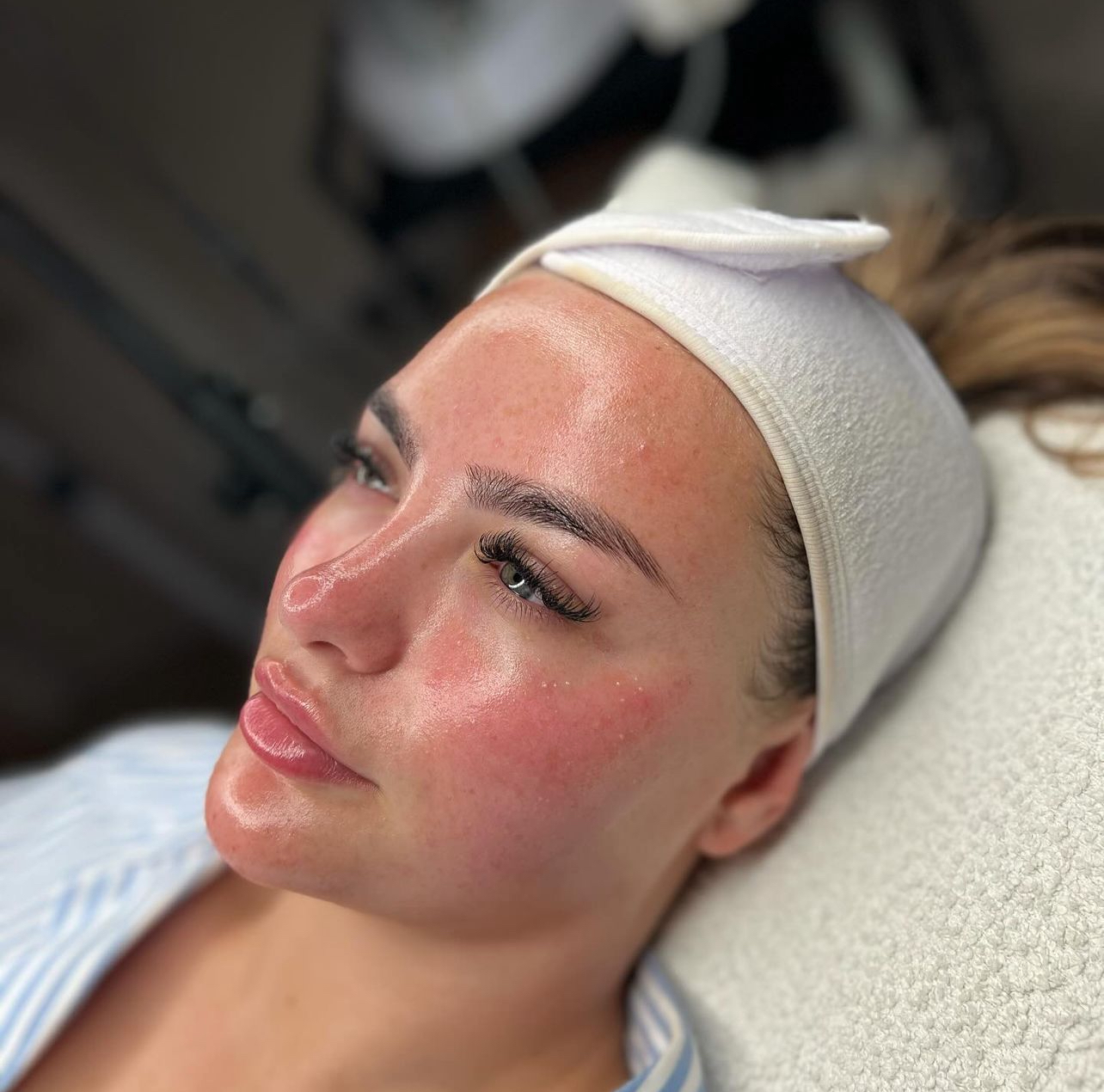 Leke Bakımı Sonrası